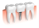 Animation of mini implant supported dental crown