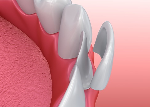 Animation of porcelain veneer placement