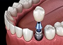 Animation of implant supported dental crown