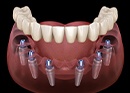 Animation of implant supported denture