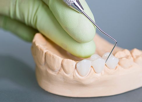 Model smile with dental bridge restoration