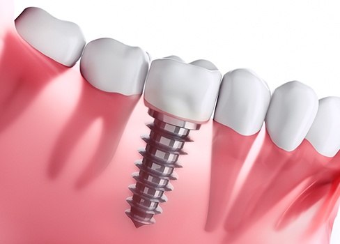 Animation of implant supported dental crown